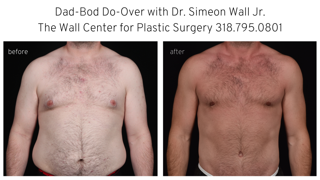 Liposuction for Men Before & After Photos Patient 149, Louisville, KY