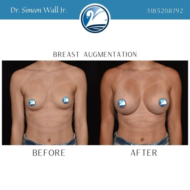 When surgical perfection matters, you call a perfectionist. Dr. Simeon Wall Jr. 318.520.8792