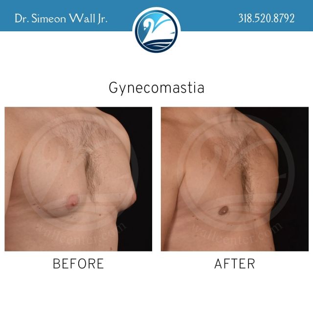 Say goodbye to gynecomastia and hello to a more confident you! Our gynecomastia surgery can help you achieve the masculine chest you’ve always wanted. Don’t let this condition hold you back any longer. Schedule a consultation with board certified plastic surgeon Dr. Simeon Wall Jr. today to learn more about how we can help you look and feel your best. #GynecomastiaSurgery #confidence #malebreastreduction #plasticsurgery #realpatientsrealresults